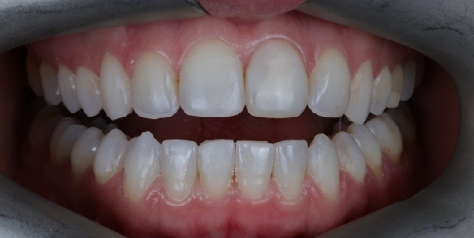 Aligners - Case 1 after