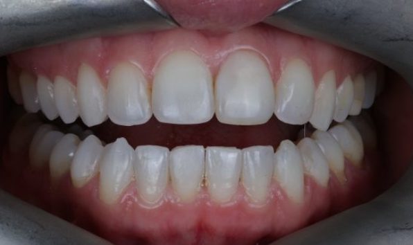Aligners - Case 1 after