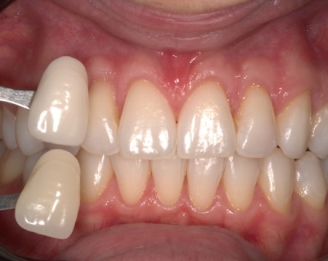 Teeth whitening case 1 after