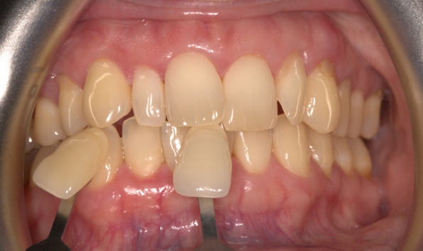 Teeth whitening - case 2 before