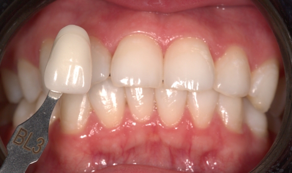 Teeth whitening - case 3 after