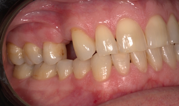 Resin-bonded bridge - case 1 before