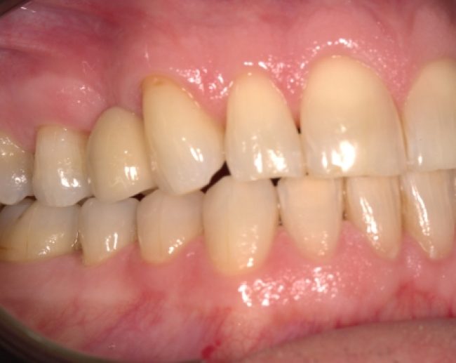 Resin-bonded bridge - case 1 after