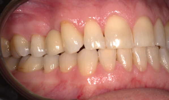 Resin-bonded bridge - case 1 after