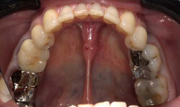 Onlay - case 1 before