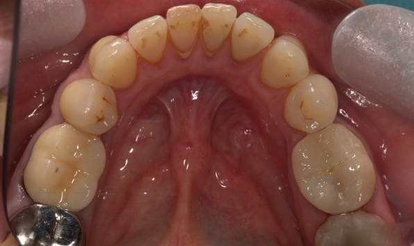 Onlay - case 1 after