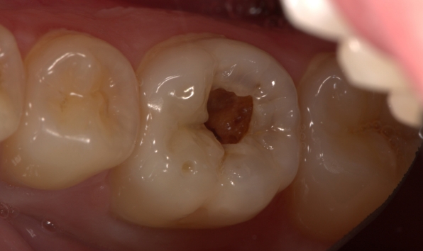 composite filling direct restoration - case 1 before
