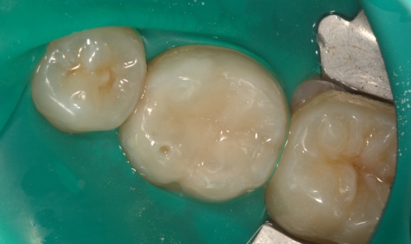 composite filling direct restoration - case 1 after
