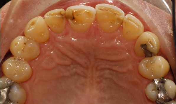 Composite bonding - case 2 before