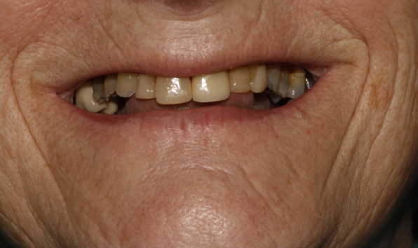 Smile makeover with crowns - case 1 before