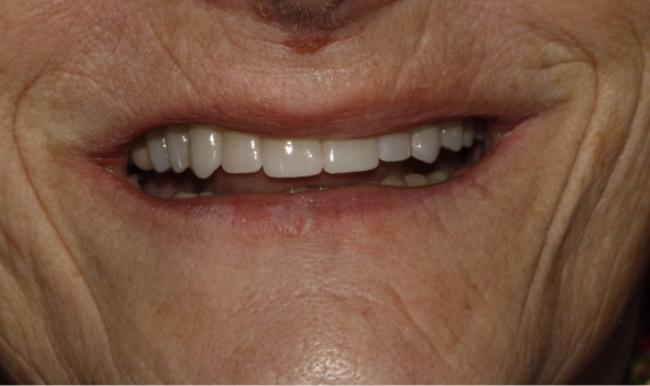 Smile makeover with crowns - case 1 after