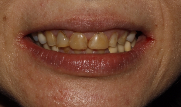 Smile makeover with crowns - case 2 before