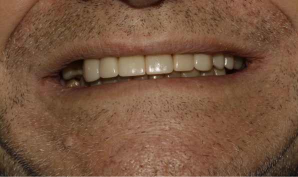 Oral rehabilitation - case 1 after