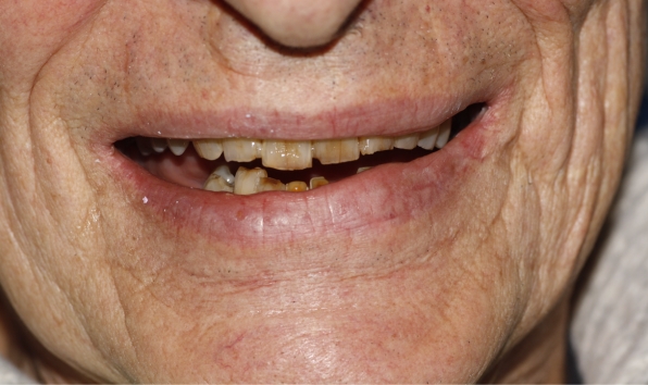 Teeth whitening and composite bonding - case 1 before
