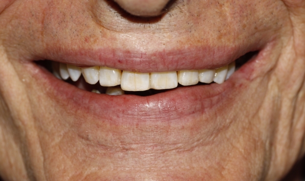 Teeth whitening and composite bonding - case 1 after