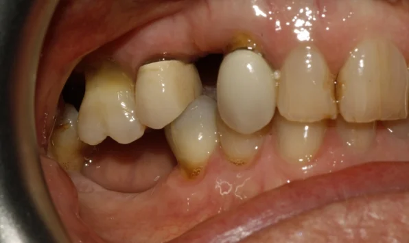 Bridges - Case 2 before