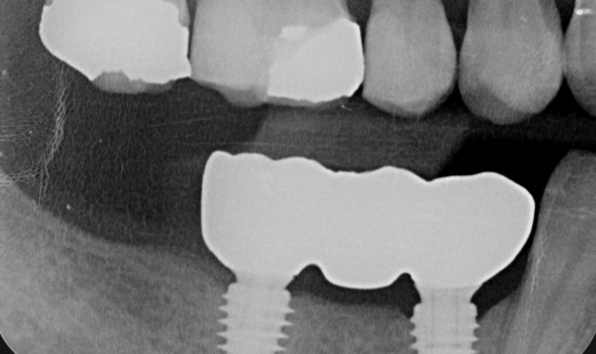 Dental implants - Case 1 after