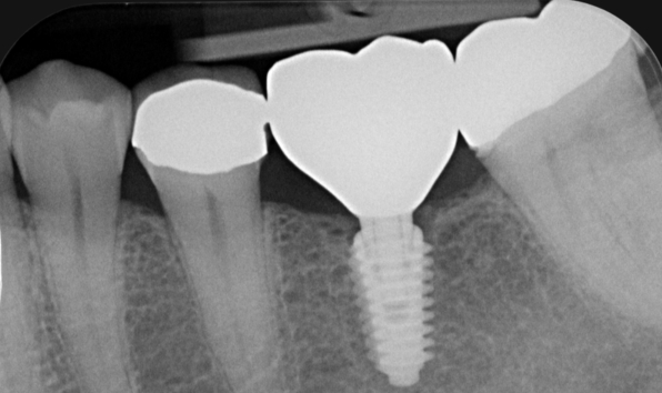 Dental implants - Case 2 after