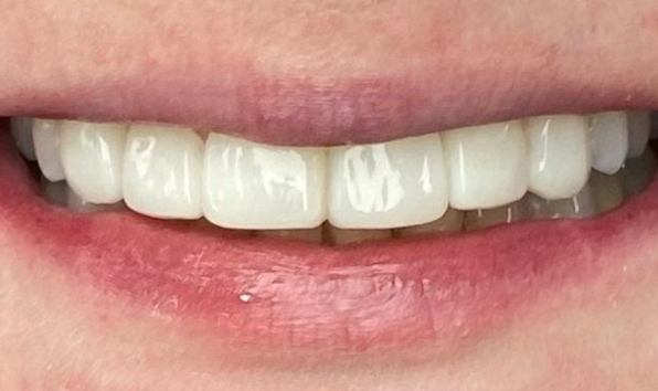 Composite bonding - case 1 after